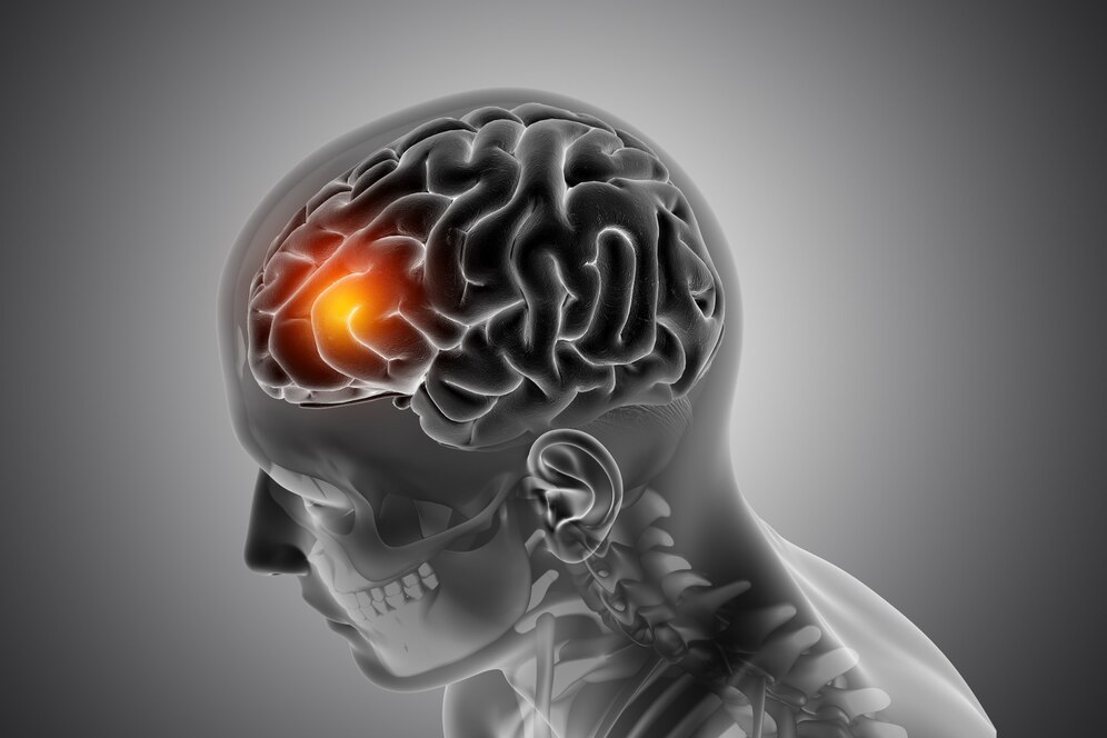Cómo se produce un coágulo cerebral